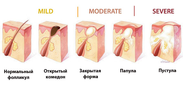 образование прыщей