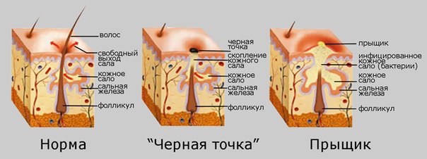 Почему появляются прыщи на лице