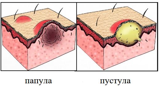 Воспаленные прыщи на лице